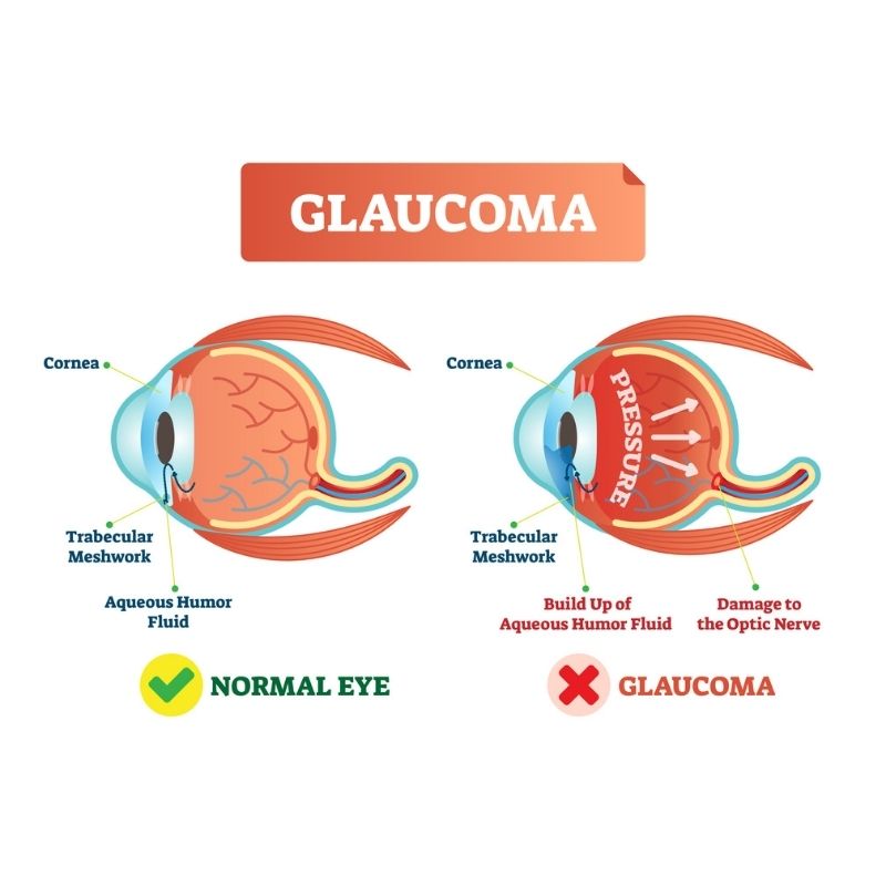 TAKE CARE OF YOUR EYES OR YOU MAY NOT SEE GLAUCOMA COMING Image